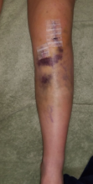 ACL Tears, Surgery, and Recovery